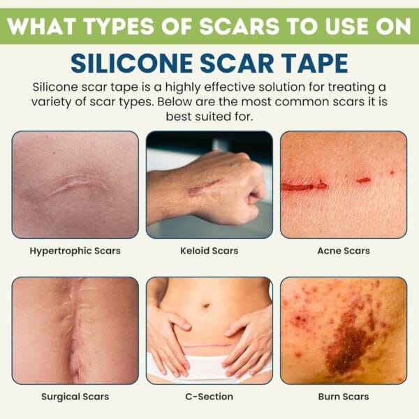 Silicone Scar Sheets - Image 3